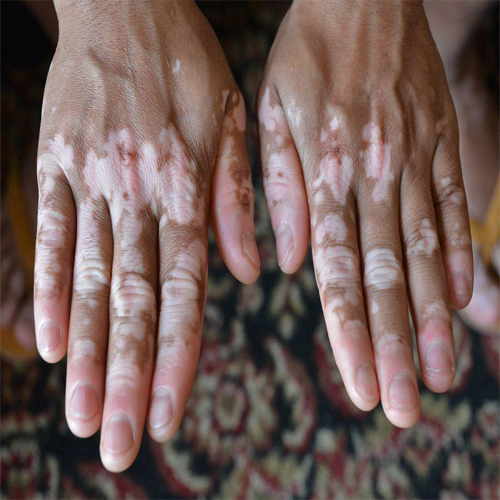 Leucoderma Vitiligo