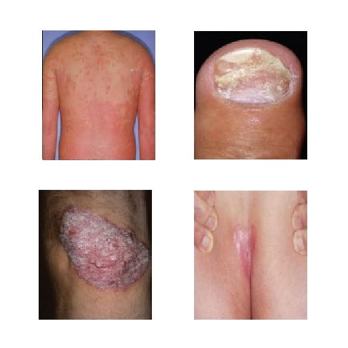 Psoriasis